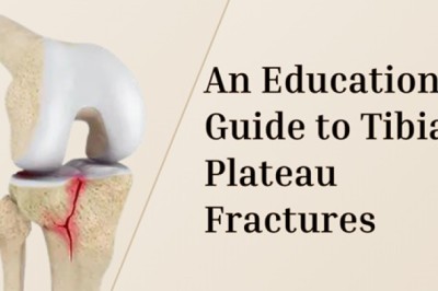 An Educational Guide to Tibial Plateau Fractures