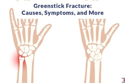 7 Critical Facts About Greenstick Fracture in Emergency Rooms Near Me