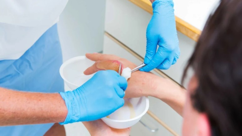 7 Powerful Burn Treatment Near Me Tips for Fast Healing